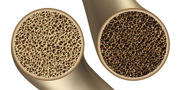 Bone Metabolism Comparison Bone Metabolism Comparison